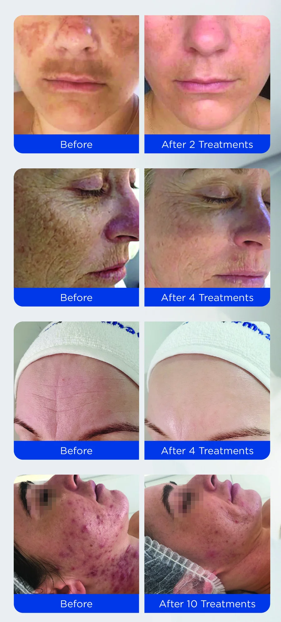 Four before and after comparisons following courses of Dermapen 4 microneedling, labelled after two, four, four and ten treatments, showing pigmentation, forehead lines and inflammatory acne.
