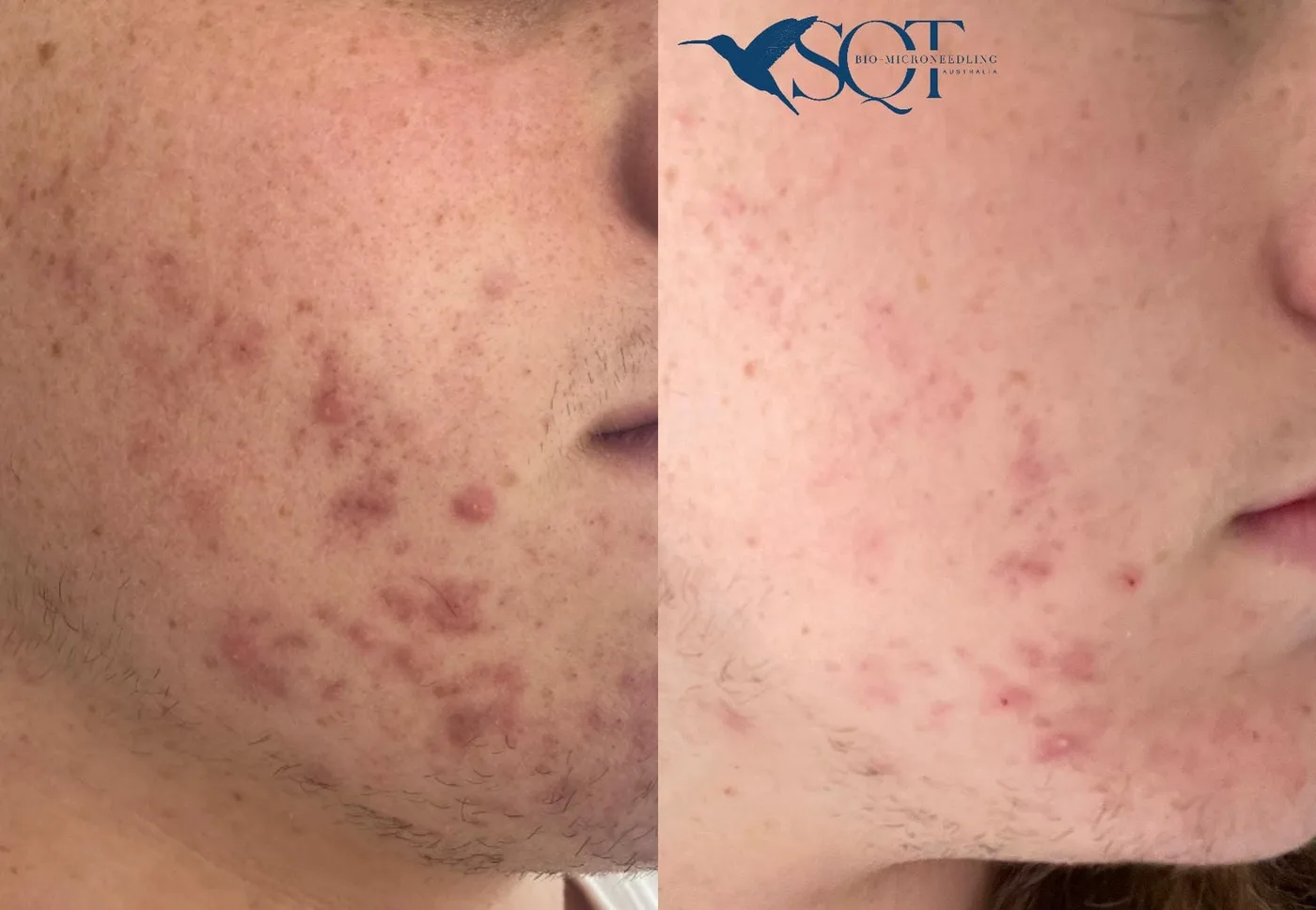 Before and after SQT bio-microneedling showing acne and post-inflammatory redness across the cheek and jaw.