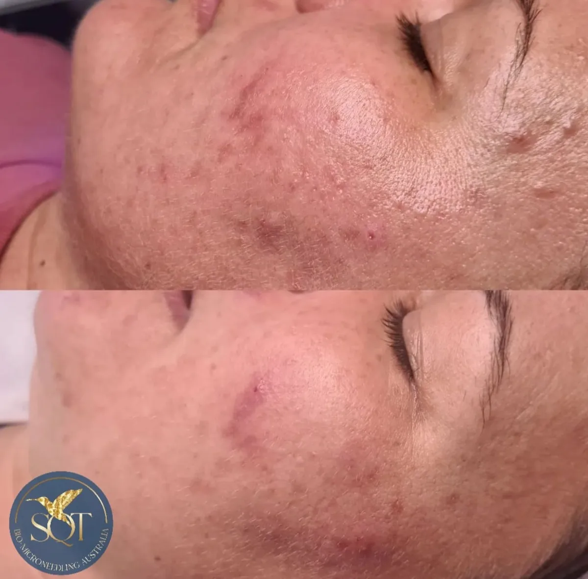 Before and after SQT bio-microneedling showing acne scarring and texture across the cheek.