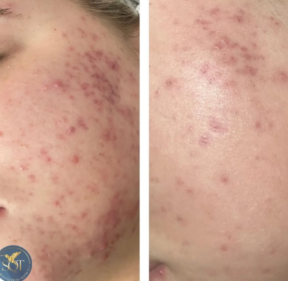 Before and after SQT bio-microneedling showing inflammatory acne across the cheek.