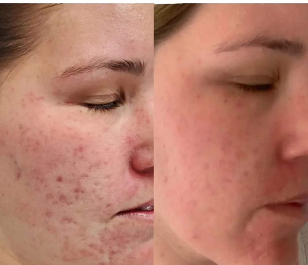 Before and after SQT bio-microneedling showing acne and redness across the cheek and jawline.